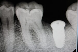 implant x ray